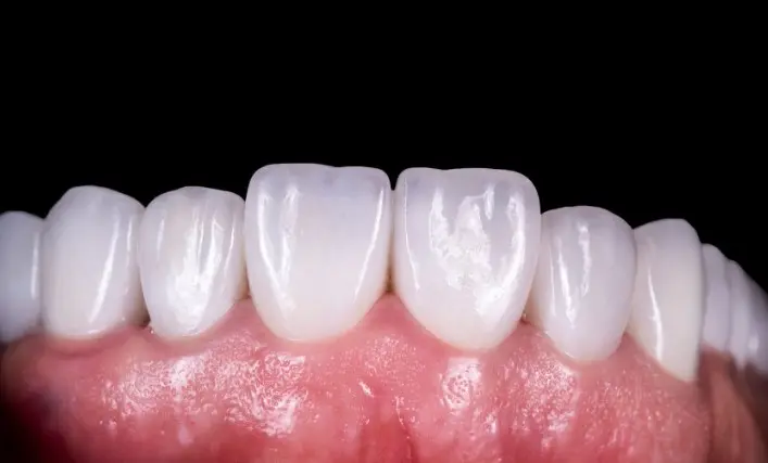 Zirconia Crowns