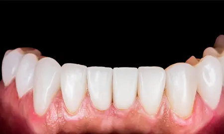 ecuadordentalvacations-before-after-5