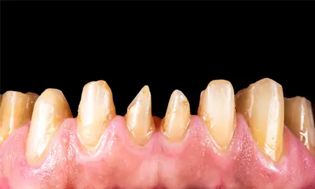 ecuadordentalvacations-before-after-6