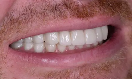 ecuadordentalvacations-before-after-8